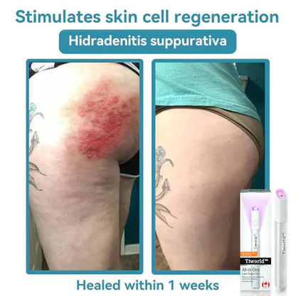 ✨TIWORLD™ All-in-One CO₂ Laser Eraser Pen | Removes Moles, Warts, Skin Flaws & Pigmentation